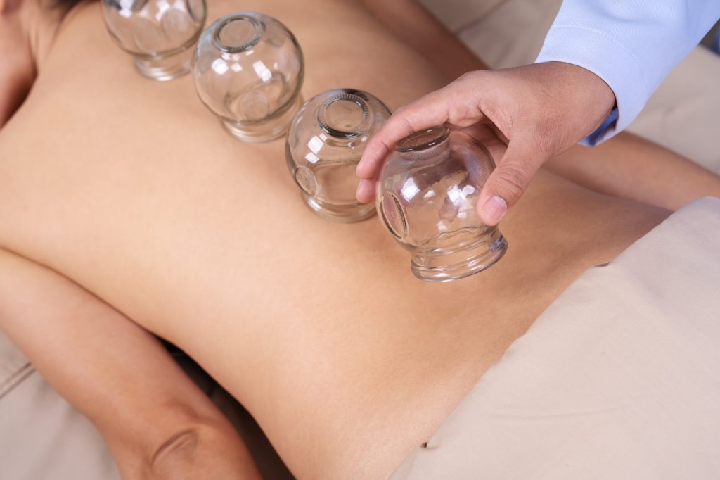 Cupping St Charles, IL